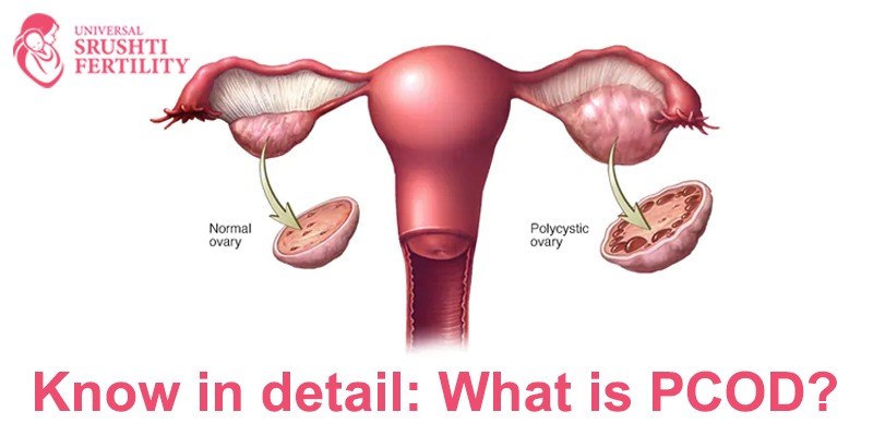 PCOD Treatment in Vijayawada