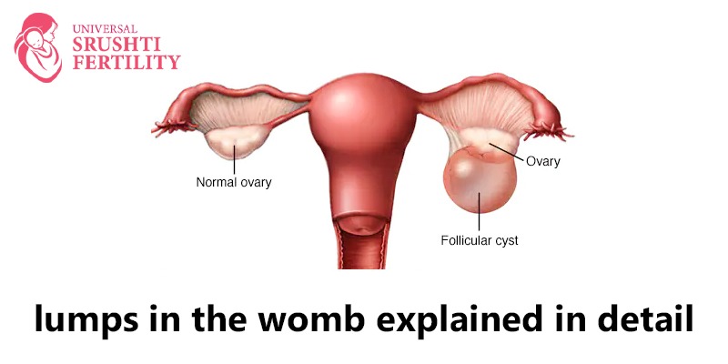 Uterine Fibroids Symptoms, Causes, Risk Factors